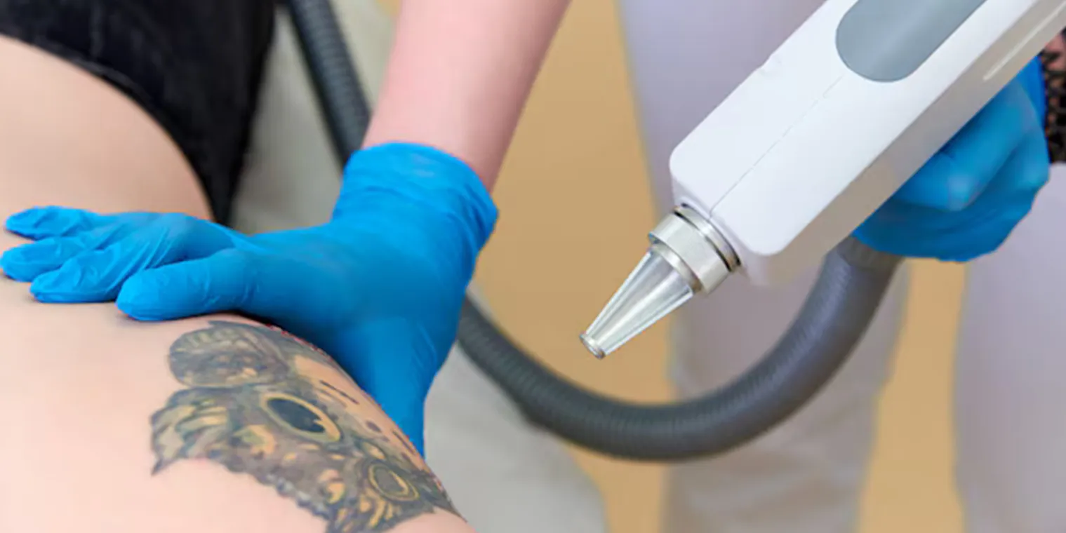 Tattoo removal