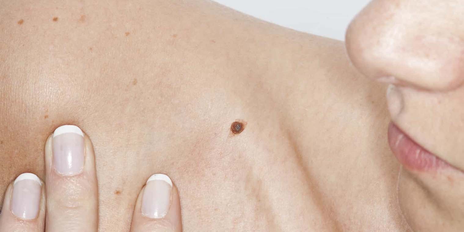 A person with mole on their shoulder