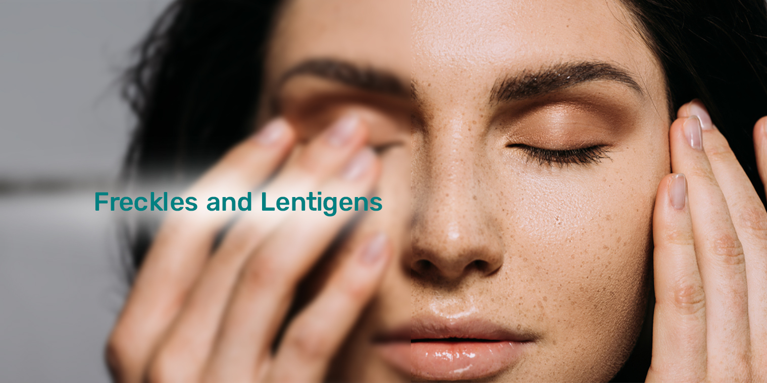 Freckles and Lentigens 