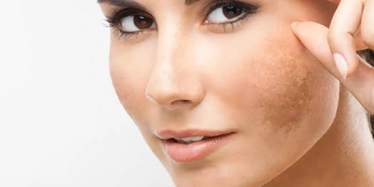 Spot and Bemishes Removal