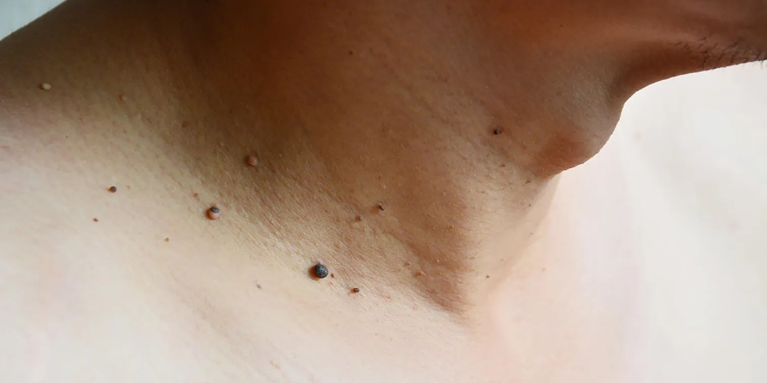 Skin Tag Removal in Noida