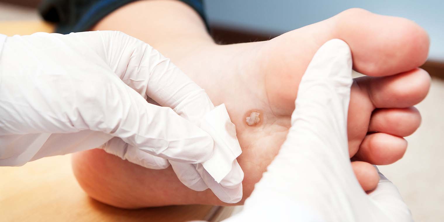 Wart Removal in Noida