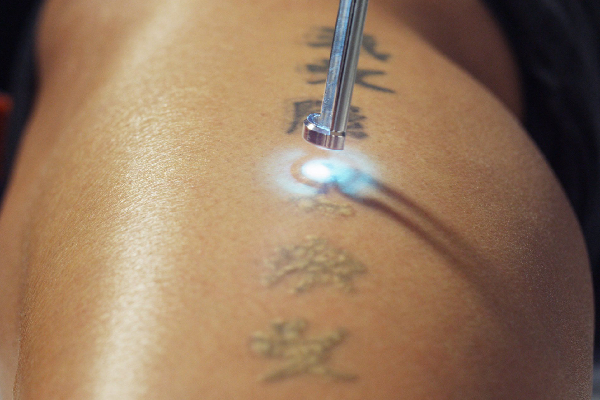 tattoo removal (ND Yag Laser)