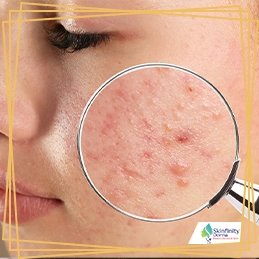 Acne Treatment