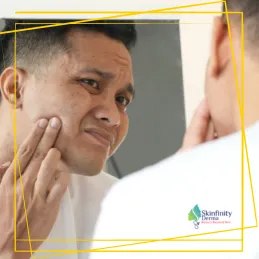 ACNE AND SCAR TREATMENT