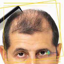 HAIR GROWTH TREATMENT